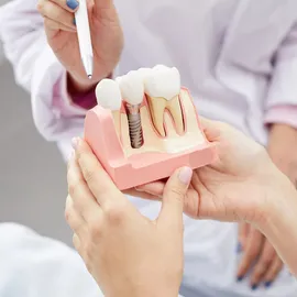 Dental Implants